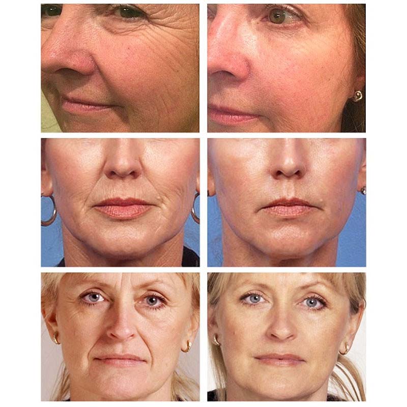 Retinol Face Cream Anti-wrinkle Skin Care Anti-Aging Firming Cosmetics Hyaluronic Acid Moisturizing Whitening Beauty Products